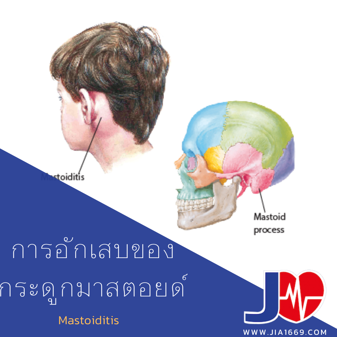 การอักเสบของกระดูกมาสตอยด์ การอักเสบของกระดูกมาสตอยด์
