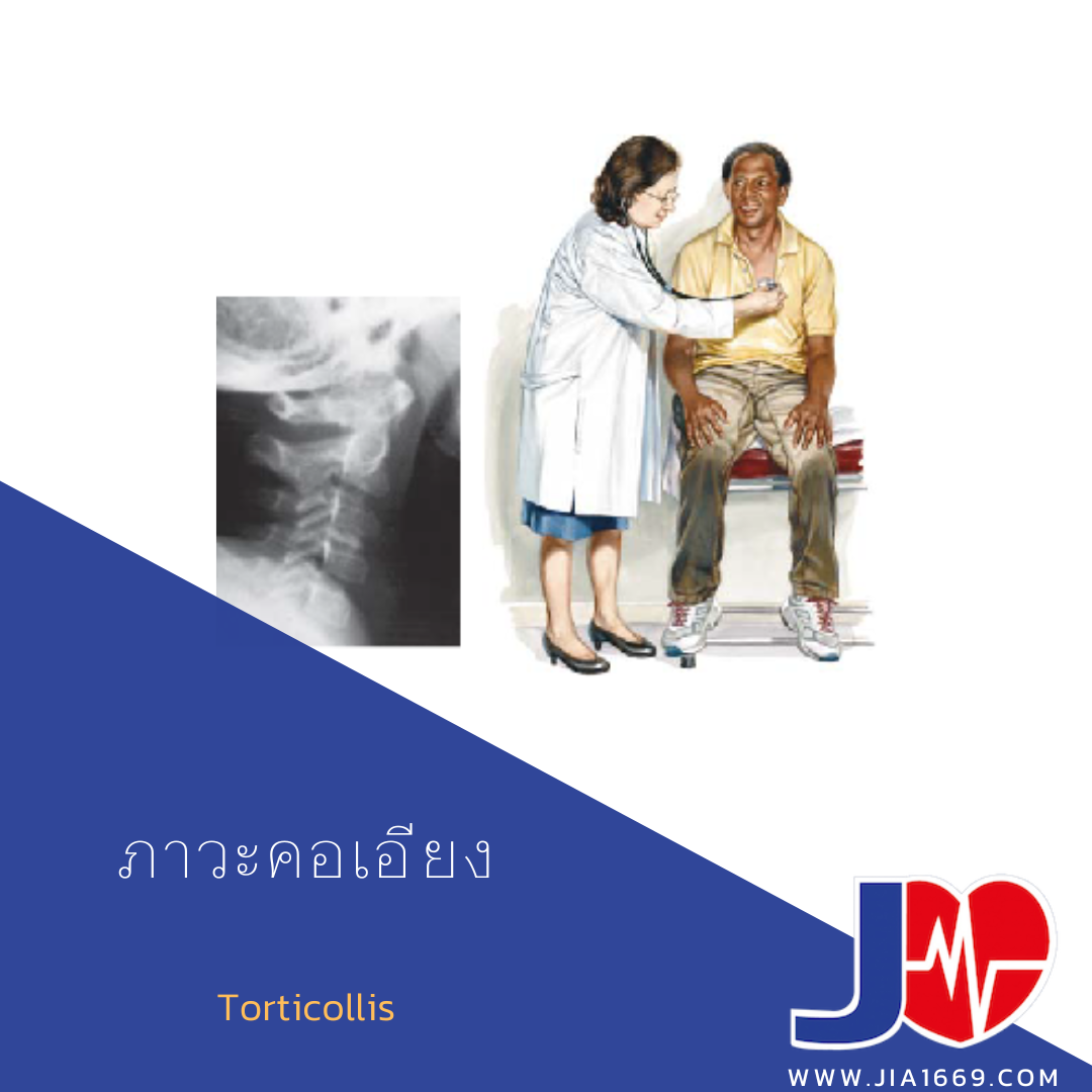 ภาวะคอเอียง ภาวะคอเอียง