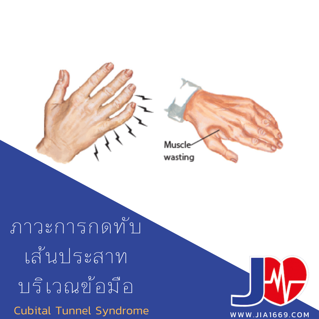 ภาวะการกดทับเส้นประสาทบริเวณข้อมือ ภาวะการกดทับเส้นประสาทบริเวณข้อมือ