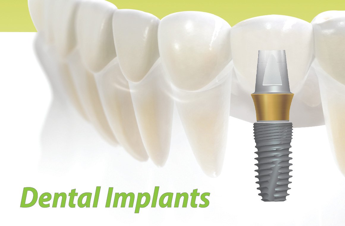 Dental Implants