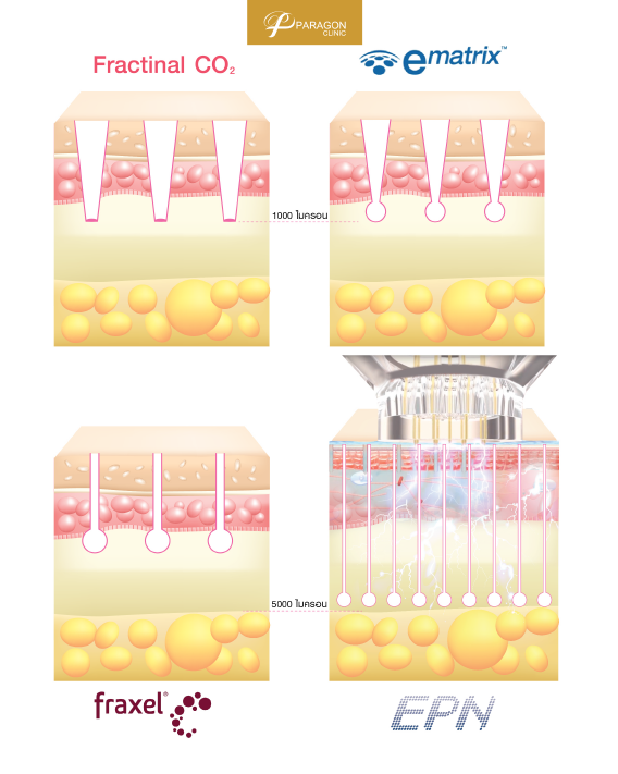 เลเซอร์หลุมสิว VS EPN Scar Repair