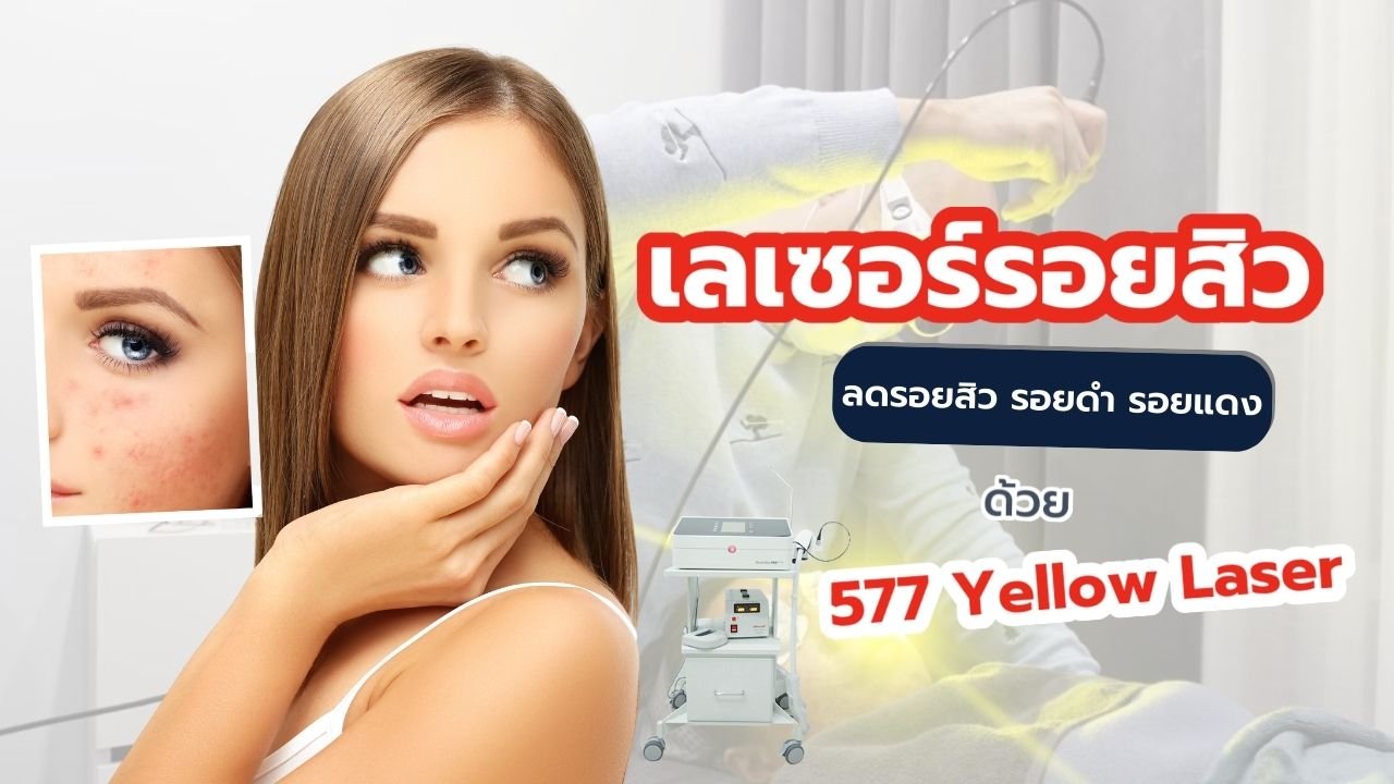 เลเซอร์ ลดรอยสิว รอยดำ รอยแดง ด้วย 577 Yellow Laser