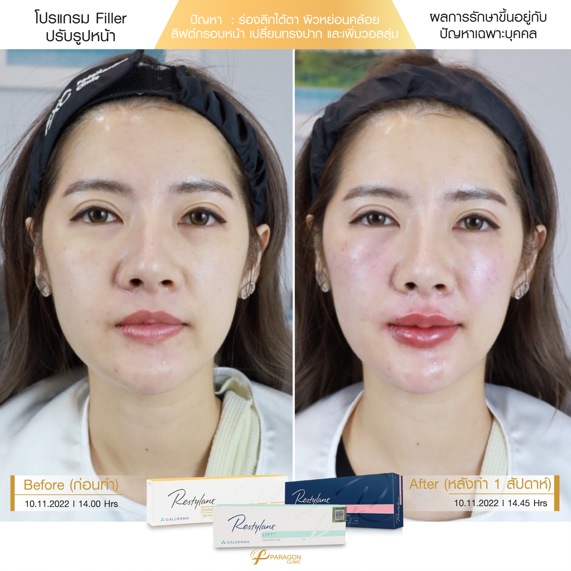 Review Filler ปรับรูปหน้า