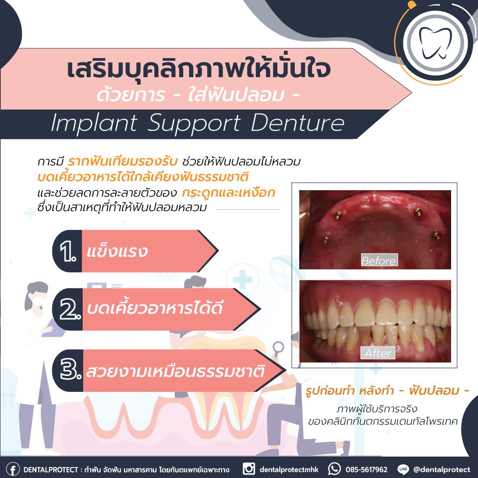 หมดปัญหาฟันปลอมหลวมด้วย Implant Support Denture