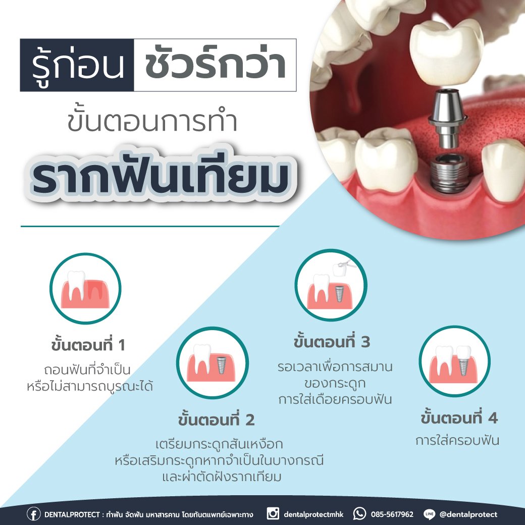 รู้ก่อน ชัวร์กว่า ขั้นตอนการทำรากฟันเทียม 