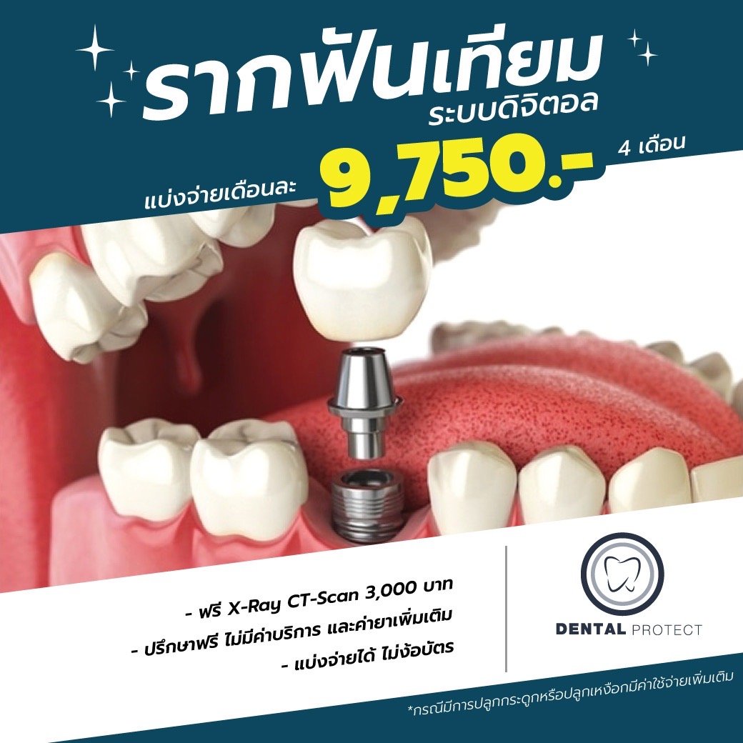 รากฟันเทียมระบบดิจิตอล  เริ่มต้น 9,750.- ต่อเดือน