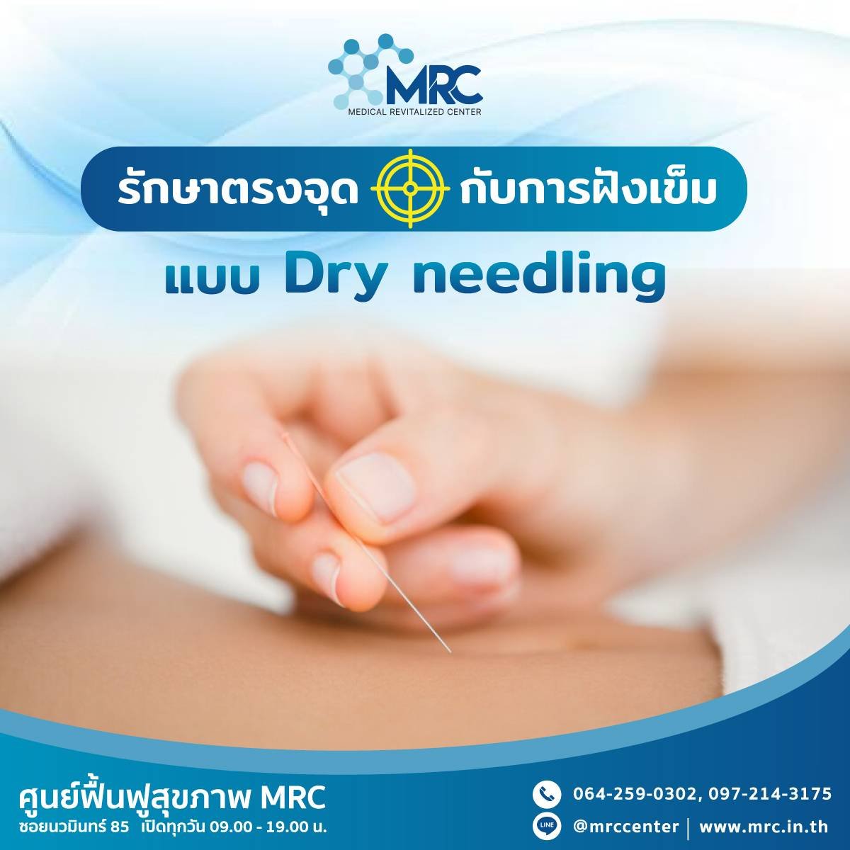 ฝังเข็ม Dry needling