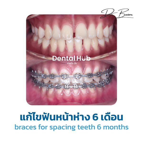 แก้ไขฟันหน้าห่าง 6 เดือน