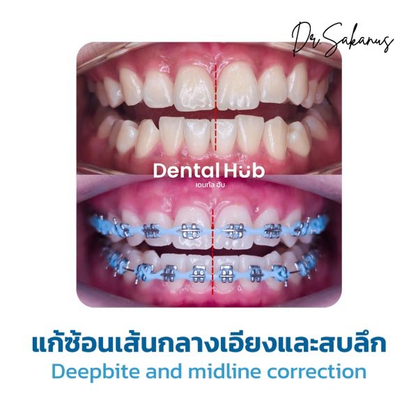 แก้ซ้อนเส้นกลางเอียงและสบลึก