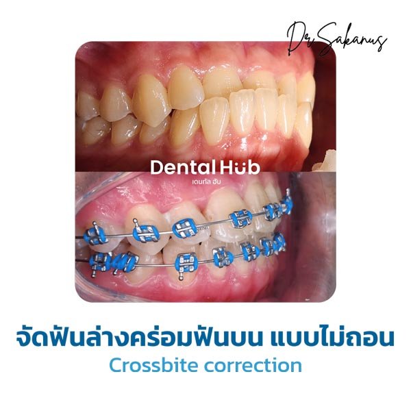 จัดฟันล่างคร่อมฟันบน แบบไม่ถอน