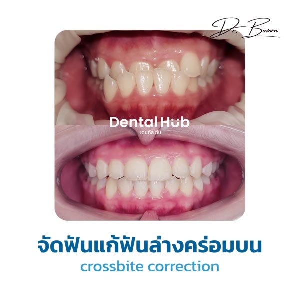 จัดฟันแก้ฟันล่างคร่อมบน