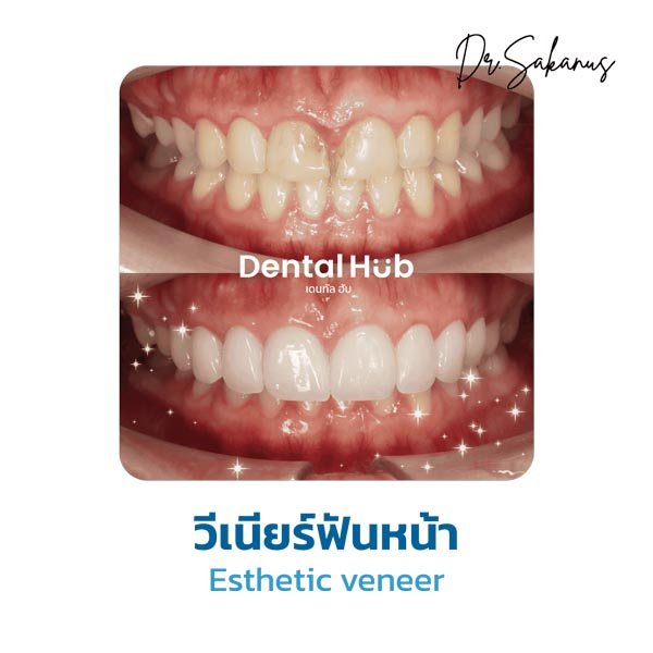 วีเนียร์ฟันหน้า