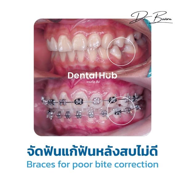 จัดฟันแก้ฟันหลังสบไม่ดี