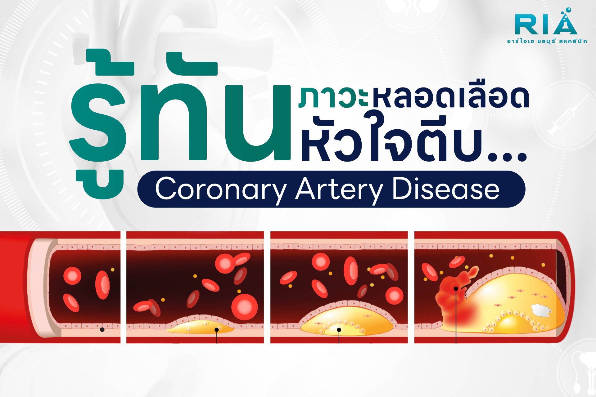 รู้ทันก่อนสาย หลอดเลือดหัวใจตีบ ไม่ได้เกิดขึ้นในวันเดียว ฟื้นฟูหลอดเลือดหัวใจ ตั้งแต่ยังไม่แสดงอาการ ด้วย EECP Therapy