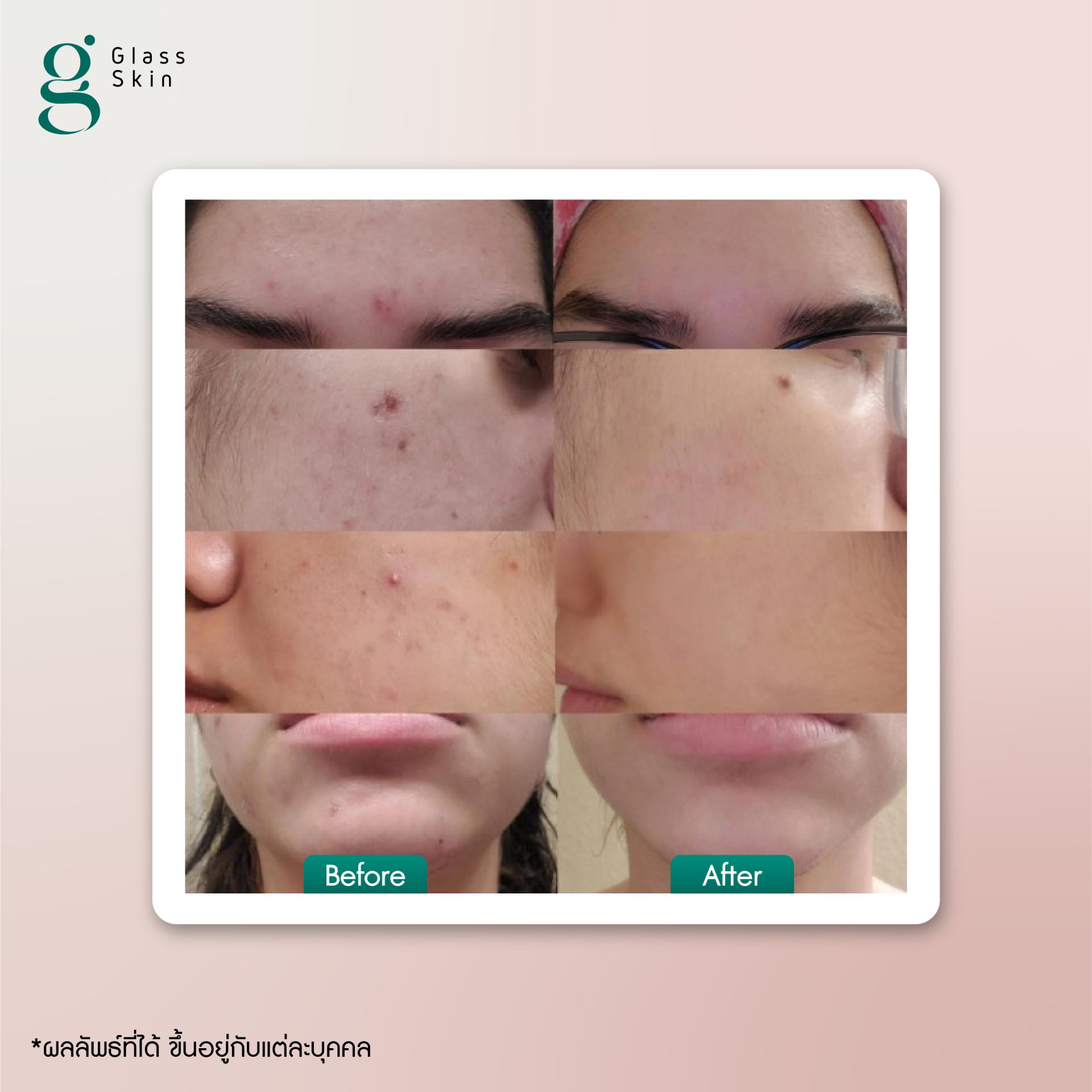 Glass Skin Beauty for Everyone ผิวดีที่ทุกคนเอื้อมถึง