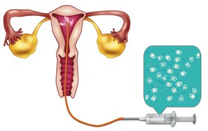 อาการการฉีดเชื้อผสมเทียมในโพรงมดลูก (IUI)