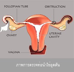 อาการท่อนำไข่อุดตัน