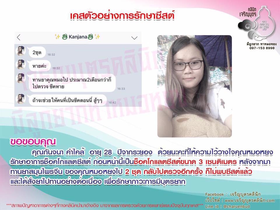 คุณกันจนา คำไคล้ อายุ 28 ปี จากระยองให้ความไว้วางใจคุณหมอหยงรักษาอาการช็อคโกแลตซีสต์