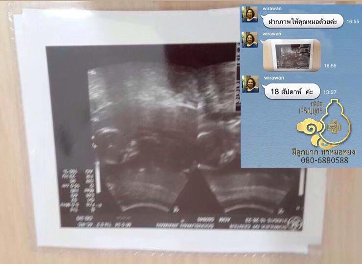 คุณวิราวัณ ซุ้นสุวรรณ อายุ42ปี จากสงขลา ตอนนี้ตั้งครรภ์18สัปดาห์แล้ว