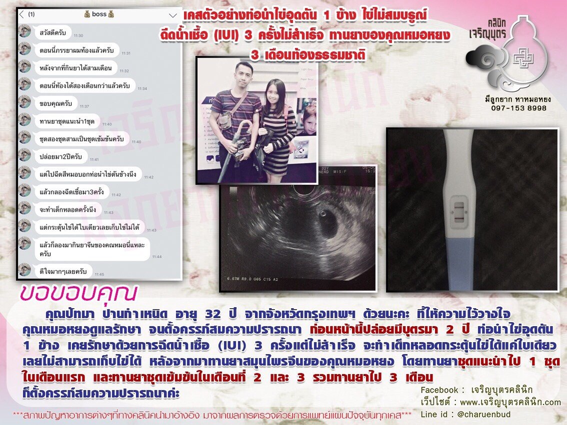 คุณปัทมา ปานกำเหนิด อายุ 32 ปี จากจังหวัดกรุงเทพฯ ให้ความไว้วางใจคุณหมอหยงดูแลรักษาจนตั้งครรภ์สมความปรารถนา
