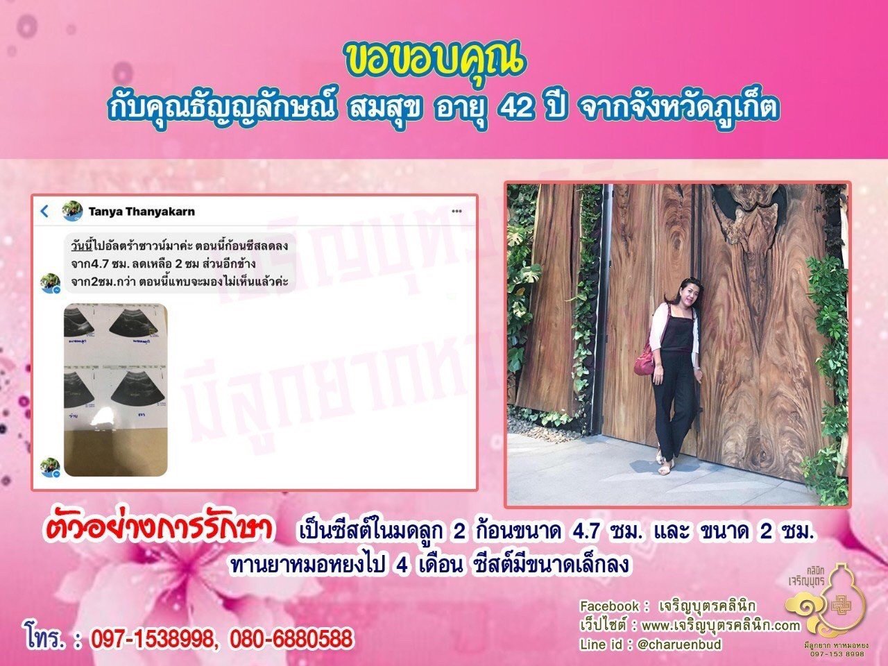 คุณธัญญลักษณ์ สมสุข อายุ 42 ปี จากจังหวัดภูเก็ตด้วยนะคะ ที่ให้ความไว้วางใจคุณหมอหยงในการดูแลรักษา