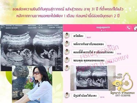 คุณสุภาภรณ์ แสงสุวรรณ อายุ 36 ปี จากสมุทรสาคร ที่ตั้งครรภ์ได้เป็นที่เรียบร้อยเเล้ว