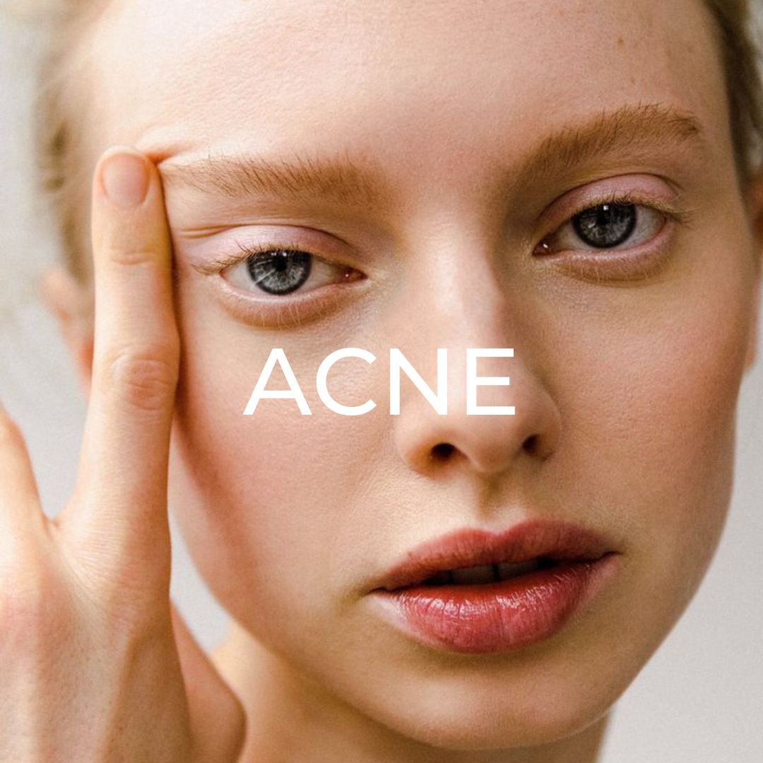 ACNE