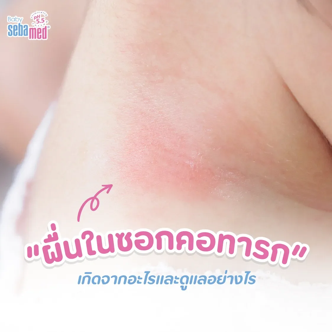 ผื่นในซอกคอ