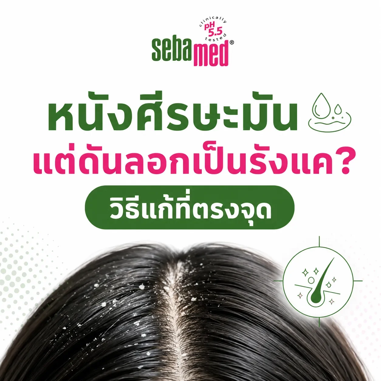 หนังศีรษะมัน_แต่ดันลอกเป็นรังแค_วิธีแก้ที่ตรงจุด