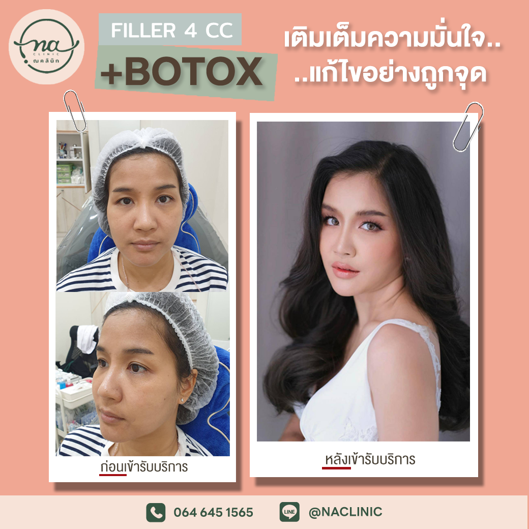 FILLER 4 CC + BOTOX