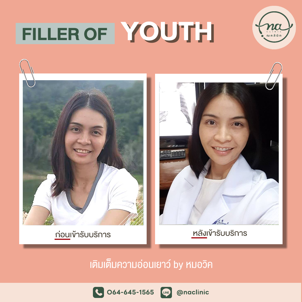 โปรแกรม Filler of youth 