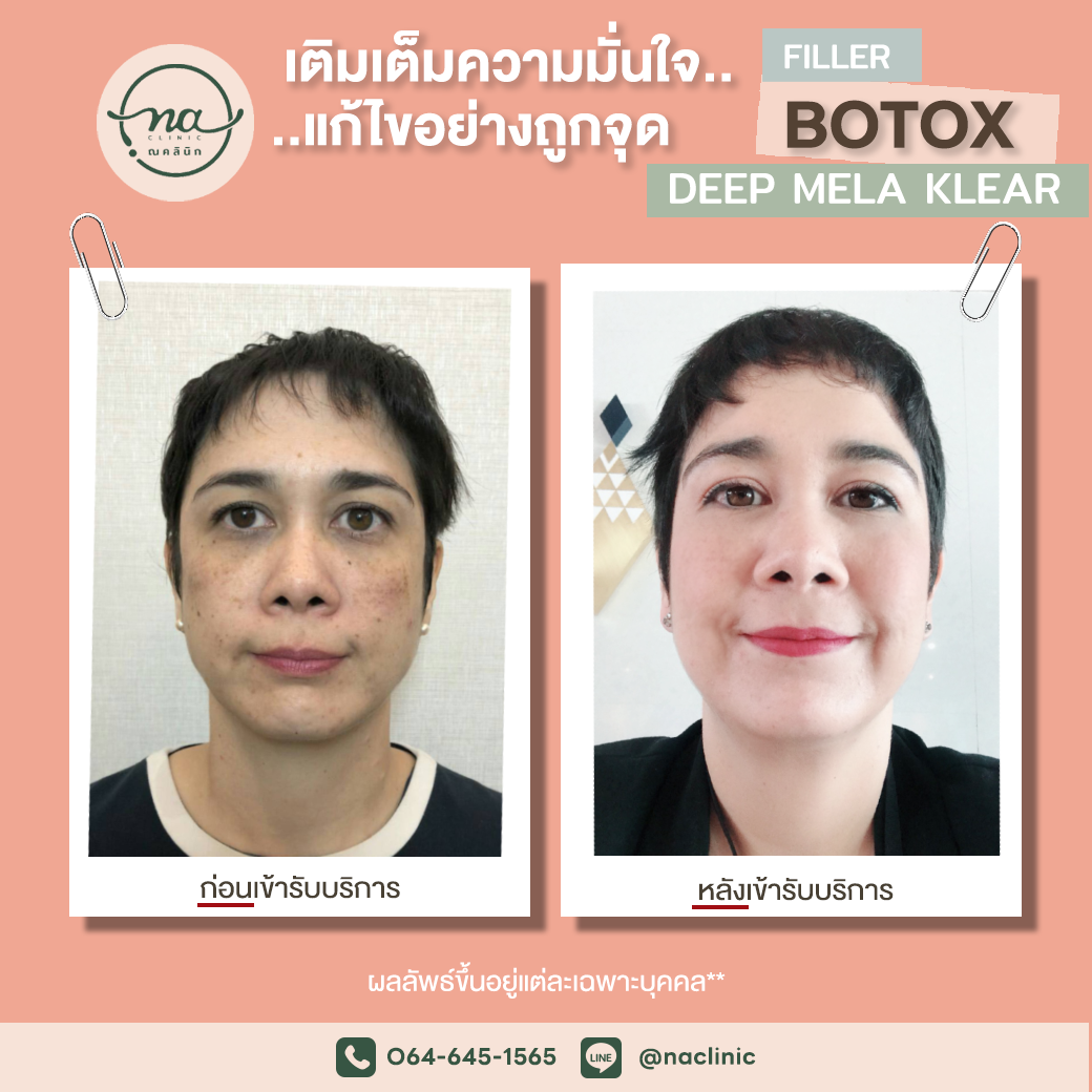 Filler+Botox และ Deep Mela Klear 