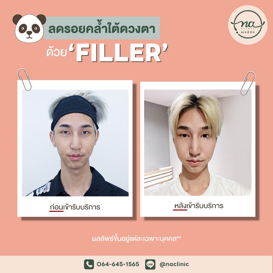 Filler ใต้ตา by หมอวิค