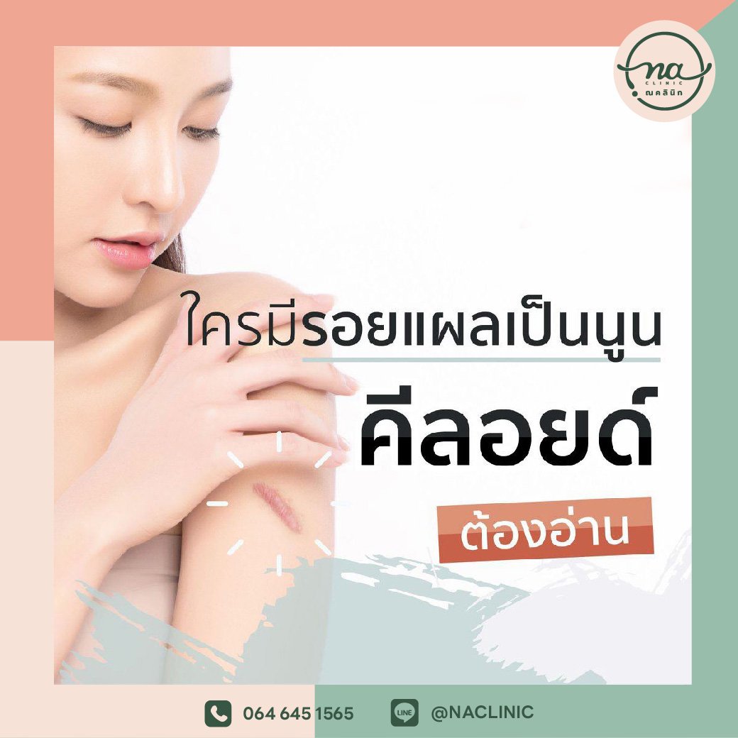 ใครมีรอยแผลเป็นนูน คีลอยด์ ต้องอ่าน !