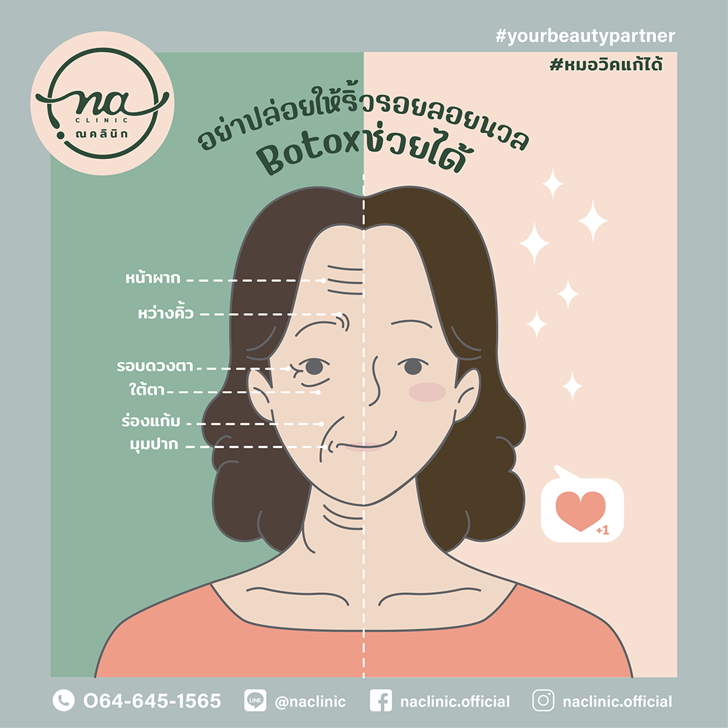 Botox ลดริ้วรอย ฉีดจุดไหนได้บ้าง ?