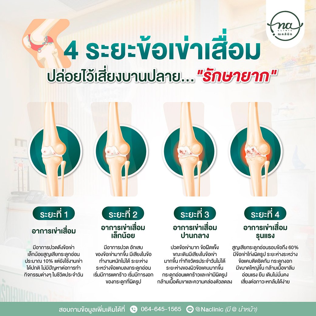 เช็คด่วน! 4 ระยะข้อเข่าเสื่อม ปล่อยไว้เสี่ยงบานปลาย... "รักษายาก"