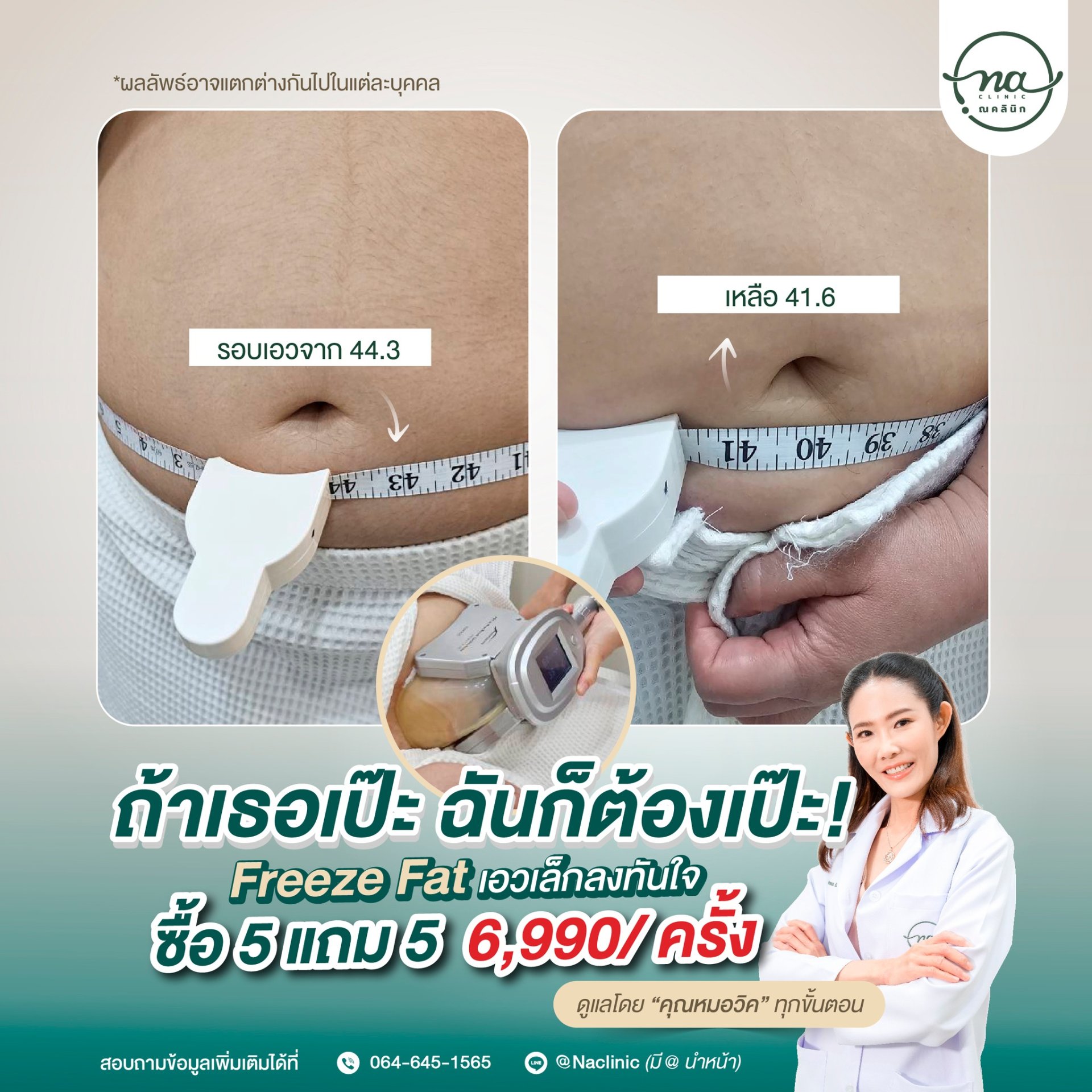 จบปัญหาพุงป่อง ไขมันย้วยด้วย Freeze Fat