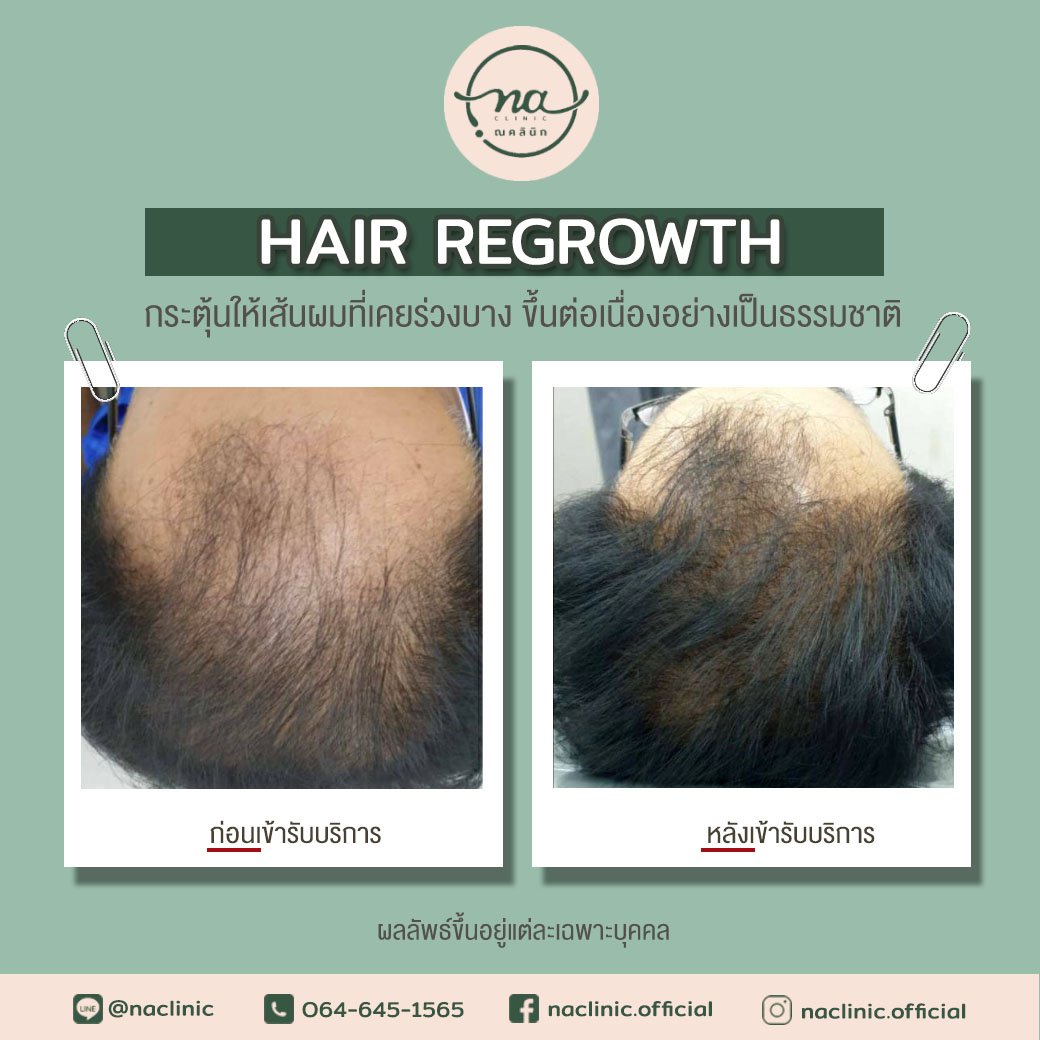 Hair Regrowth กระตุ้นผมใหม่ขึ้นต่อเนื่องอย่างเป็นธรรมชาติ