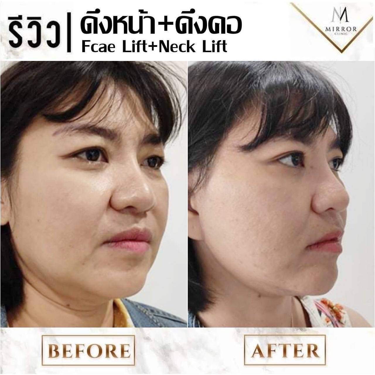 รีวิวดึงหน้าดึงคอ