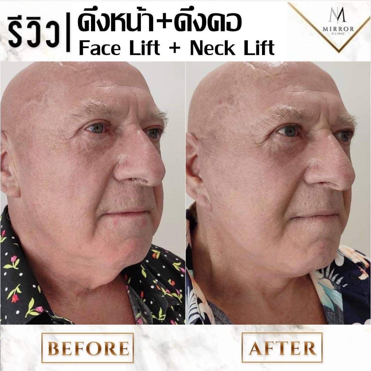 รีวิวดึงหน้าดึงคอ