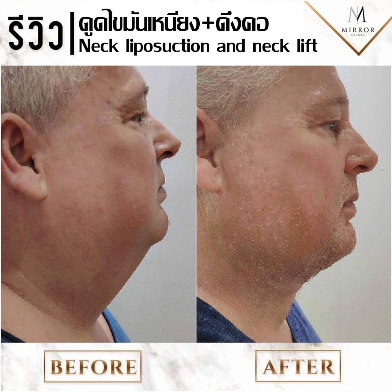 รีวิวดึงหน้าดึงคอ