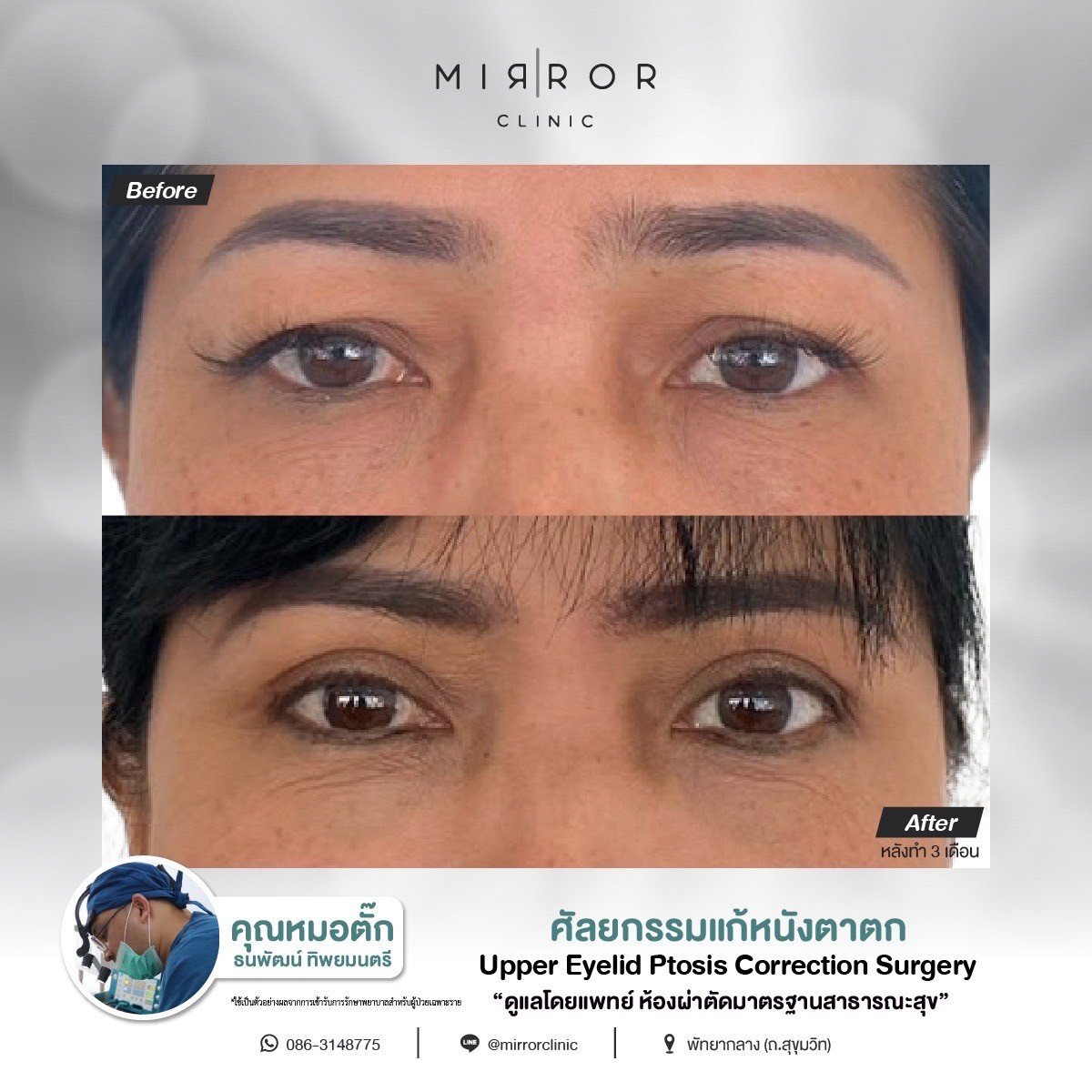 Upper / Lower Eyelids