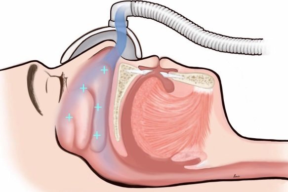 อันตรายและข้อควรระวังจากการใช้ CPAP โดยไม่ได้พบแพทย์ อันตรายและข้อควรระวังจากการใช้ CPAP โดยไม่ได้พบแพทย์