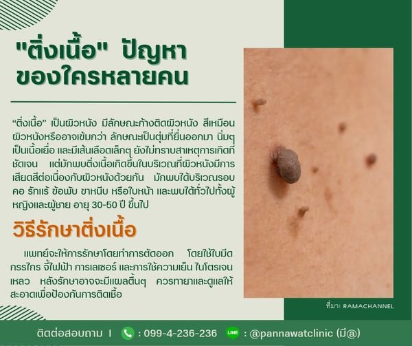 "ติ่งเนื้อ"  ปัญหาของใครหลายคน "ติ่งเนื้อ"  ปัญหาของใครหลายคน