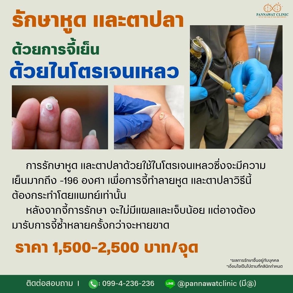 ไนโตรเจนเหลวการรักษาหูด  ไนโตรเจนเหลวการรักษาหูด