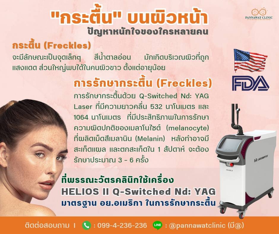 ✅ การรักษากระตื้น (Freckles) ด้วย Q-Switched Nd: YAG Laser  ✅ การรักษากระตื้น (Freckles) ด้วย Q-Switched Nd: YAG Laser
