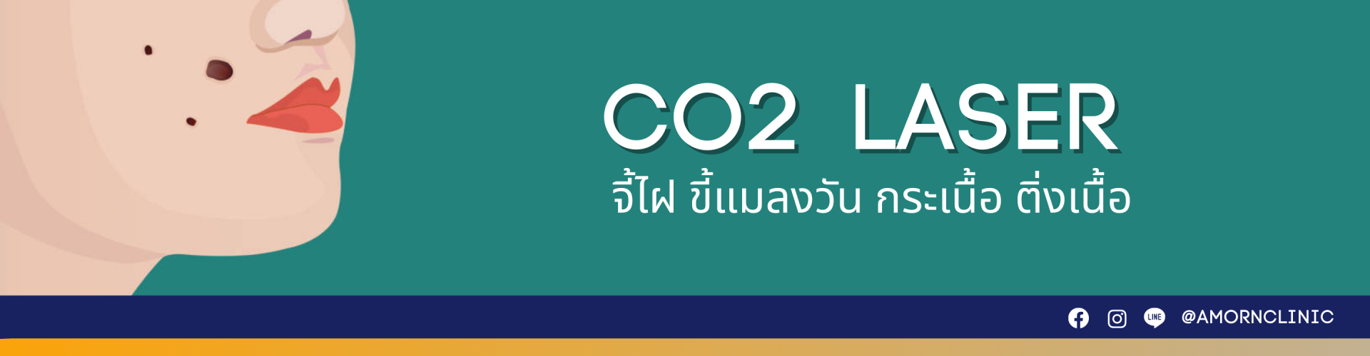 Co2 Laser (กำจัดไฝ ขี้แมลงวัน ติ่งเนื้อ กระเนื้อ สิวหิน)