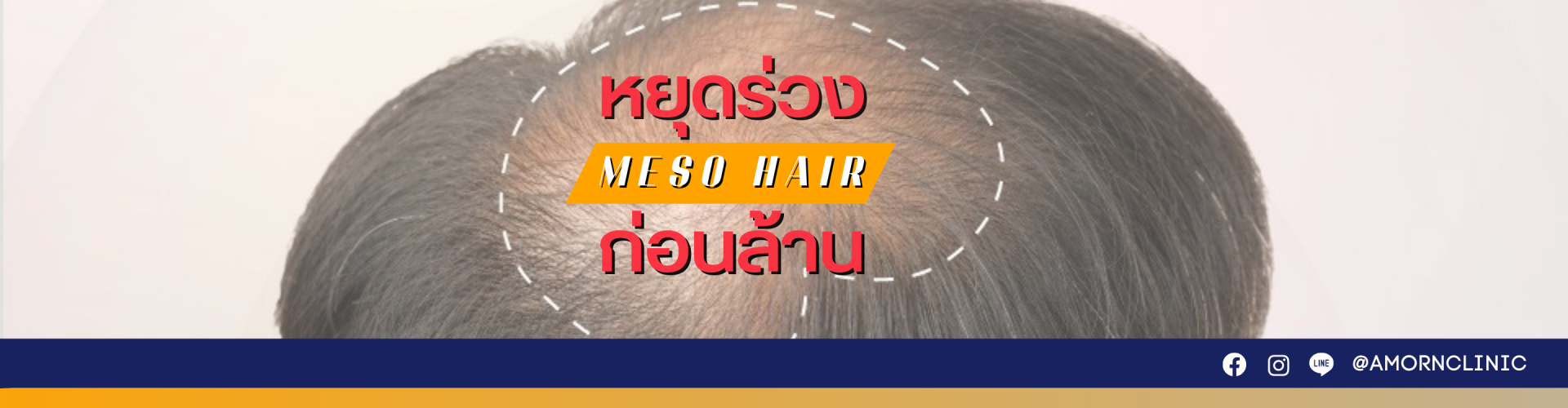 Meso Hair (เมโสปลูกผม)