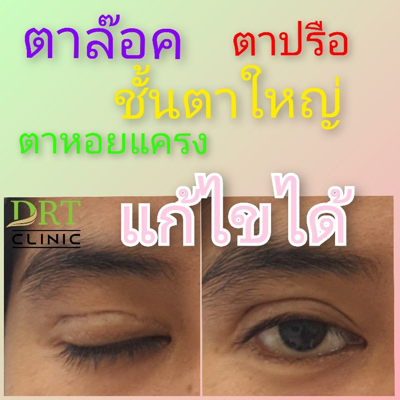 ตาหอยแครงหลังผ่าตัด (ชั้นตาล๊อค) ตาหอยแครงหลังผ่าตัด (ชั้นตาล๊อค)