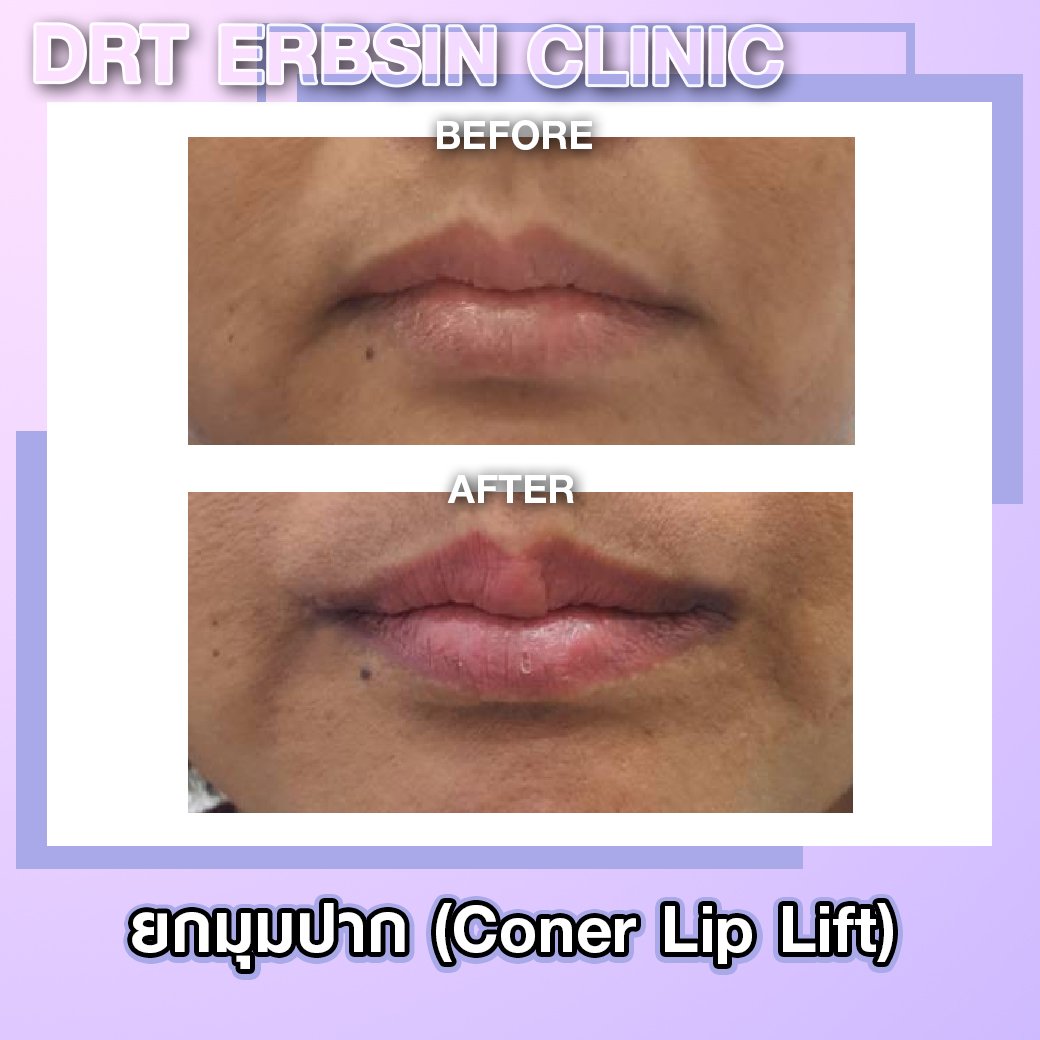 lipcornerlift